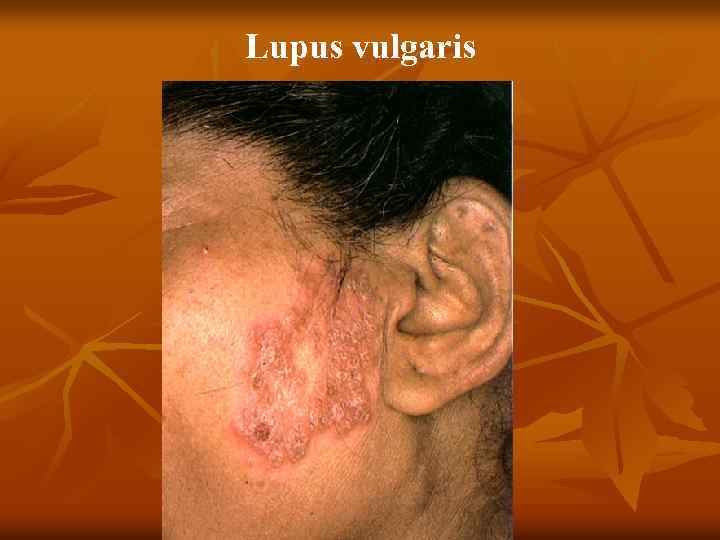 Lupus vulgaris 