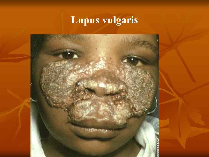 Lupus vulgaris 