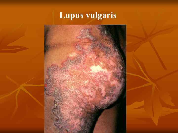 Lupus vulgaris 