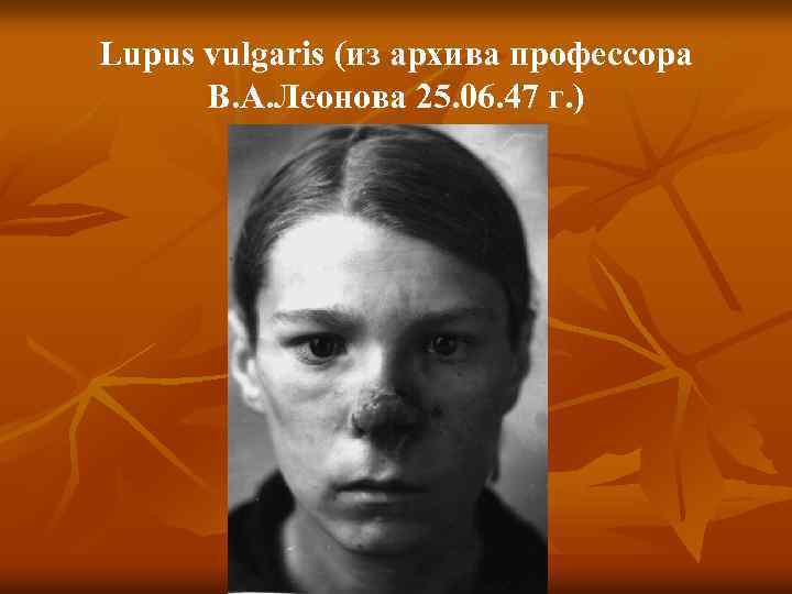 Lupus vulgaris (из архива профессора В. А. Леонова 25. 06. 47 г. ) 