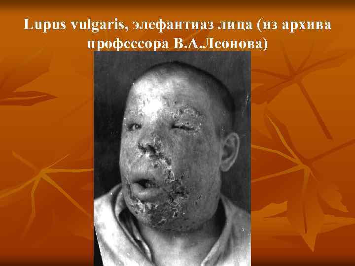 Lupus vulgaris, элефантиаз лица (из архива профессора В. А. Леонова) 