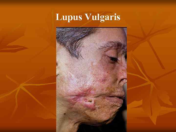 Lupus Vulgaris 
