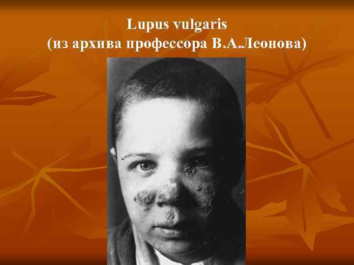 Lupus vulgaris (из архива профессора В. А. Леонова) 