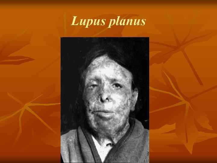 Lupus planus 
