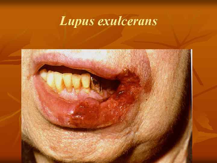 Lupus exulcerans 