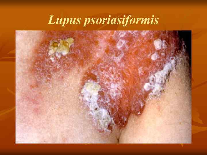 Lupus psoriasiformis 