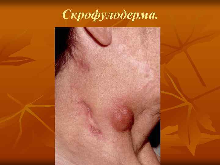 Cкрофулодерма. 