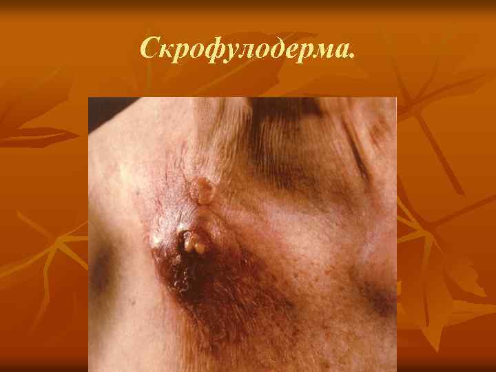 Cкрофулодерма. 