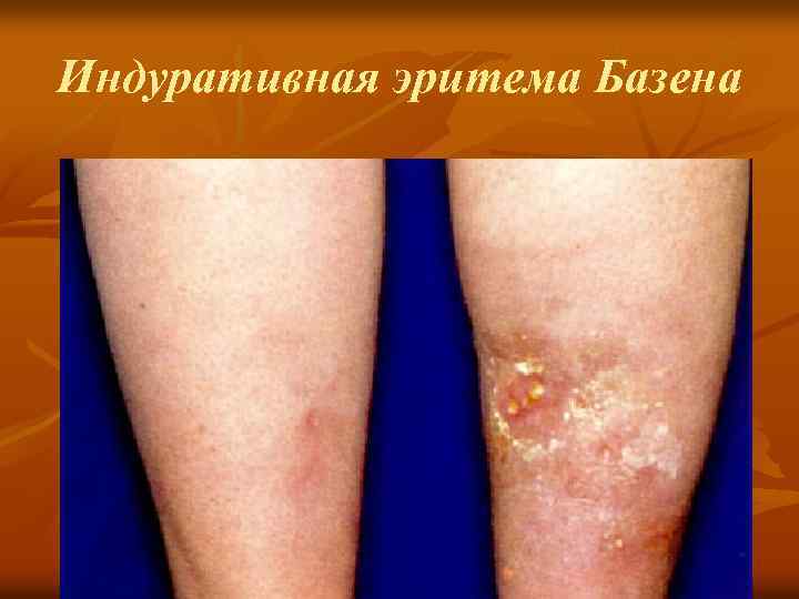 Индуративная эритема Базена 