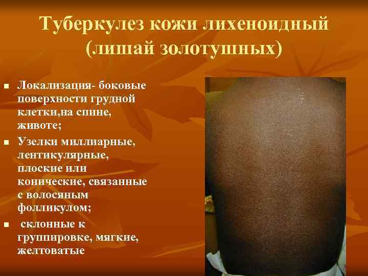 Туберкулез кожи лихеноидный (лишай золотушных) n n n Локализация- боковые поверхности грудной клетки, на
