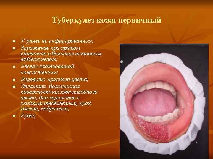 Туберкулез кожи первичный n n n У ранее не инфицированных; Заражение при прямом контакте