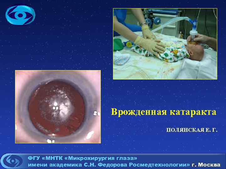 Врожденная катаракта ПОЛЯНСКАЯ Е. Г. ФГУ «МНТК «Микрохирургия глаза» имени академика С. Н. Федорова