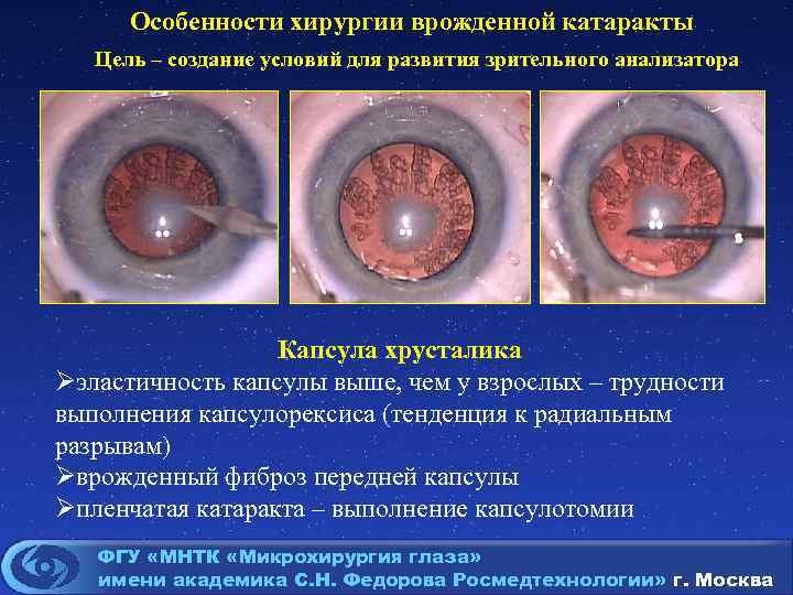 Патоморфологическая картина хронического катарального гингивита