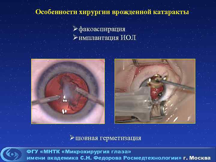 Особенности хирургии врожденной катаракты Øфакоаспирация Øимплантация ИОЛ Øшовная герметизация ФГУ «МНТК «Микрохирургия глаза» имени