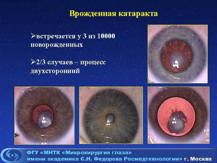 Врожденная катаракта Øвстречается у 3 из 10000 новорожденных Ø 2/3 случаев – процесс двухсторонний
