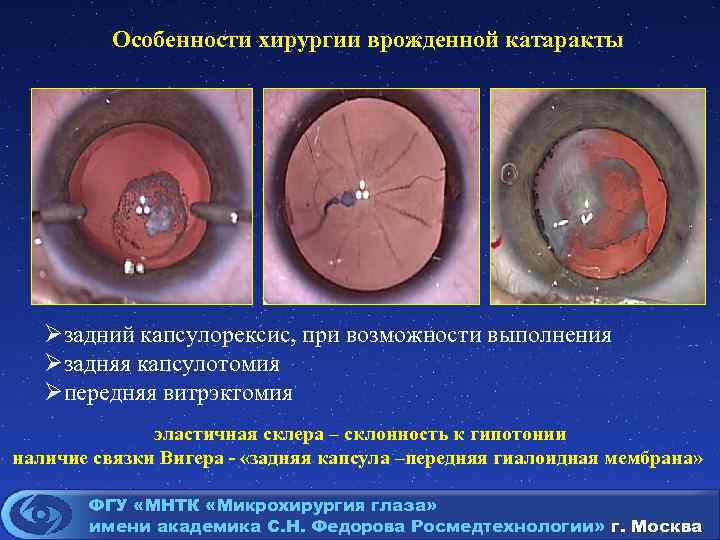 Особенности хирургии врожденной катаракты Øзадний капсулорексис, при возможности выполнения Øзадняя капсулотомия Øпередняя витрэктомия эластичная