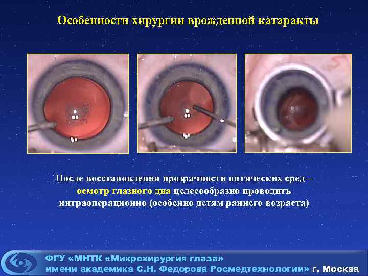 Особенности хирургии врожденной катаракты После восстановления прозрачности оптических сред – осмотр глазного дна целесообразно