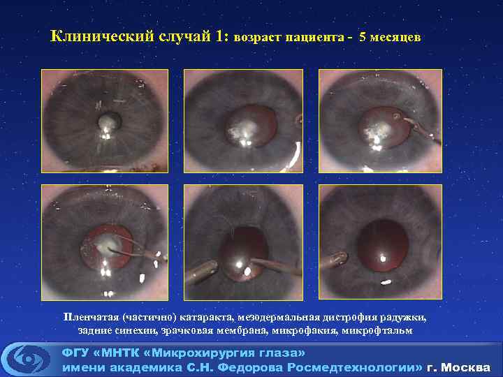 Клинический случай 1: возраст пациента - 5 месяцев Пленчатая (частично) катаракта, мезодермальная дистрофия радужки,