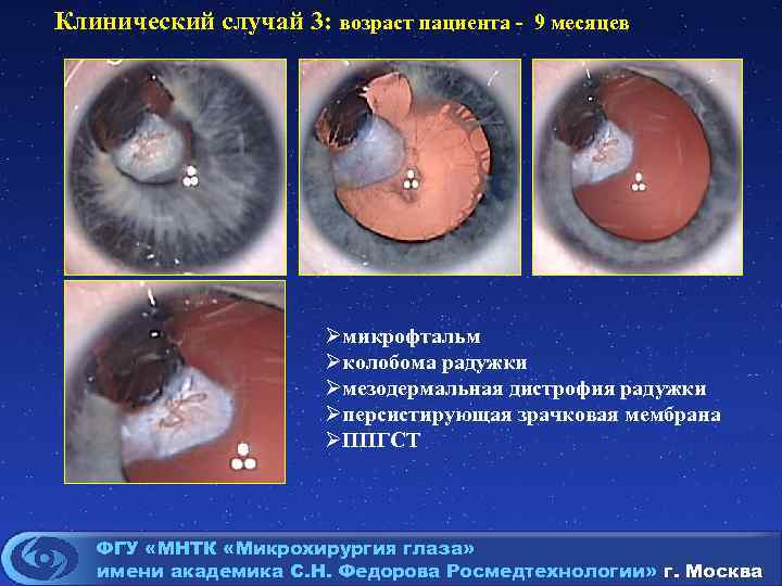 Клинический случай 3: возраст пациента - 9 месяцев Øмикрофтальм Øколобома радужки Øмезодермальная дистрофия радужки