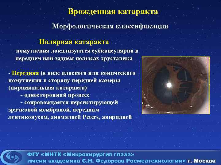 Врожденная катаракта Морфологическая классификация Полярная катаракта – помутнения локализуются субкапсулярно в переднем или заднем