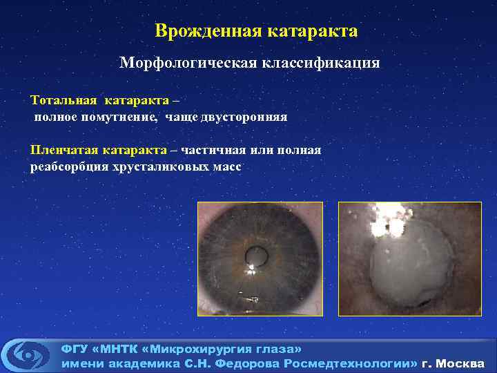 Врожденная катаракта Морфологическая классификация Тотальная катаракта – полное помутнение, чаще двусторонняя Пленчатая катаракта –