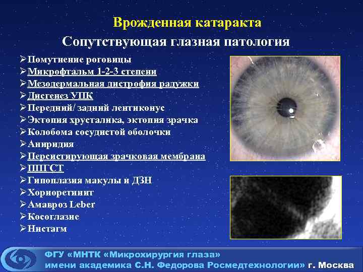 Врожденная катаракта Сопутствующая глазная патология ØПомутнение роговицы ØМикрофтальм 1 -2 -3 степени ØМезодермальная дистрофия