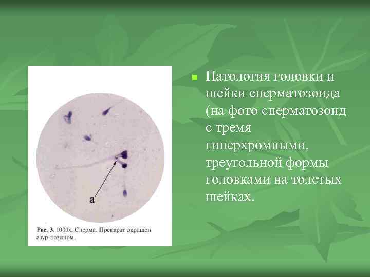 n Патология головки и шейки сперматозоида (на фото сперматозоид с тремя гиперхромными, треугольной формы