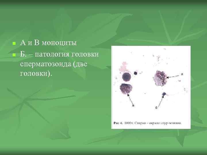 n n А и В моноциты Б. – патология головки сперматозоида (две головки). 