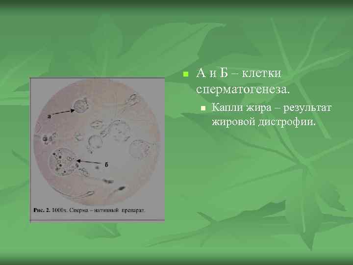 n А и Б – клетки сперматогенеза. n Капли жира – результат жировой дистрофии.