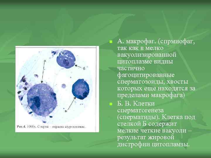 n n А. макрофаг. (спрмиофаг, так как в мелко вакуолизированной цитоплазме видны частично фагоцитированные
