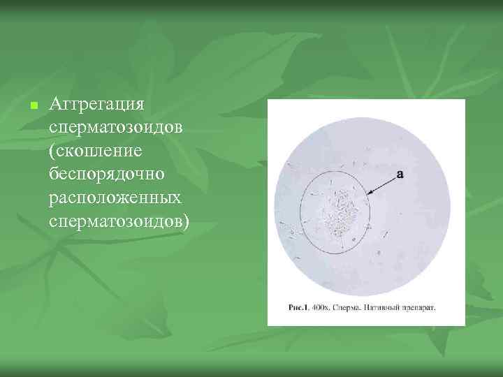 n Аггрегация сперматозоидов (скопление беспорядочно расположенных сперматозоидов) 