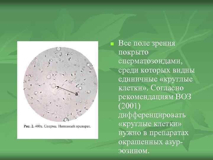 n Все поле зрения покрыто сперматозоидами, среди которых видны единичные «круглые клетки» . Согласно