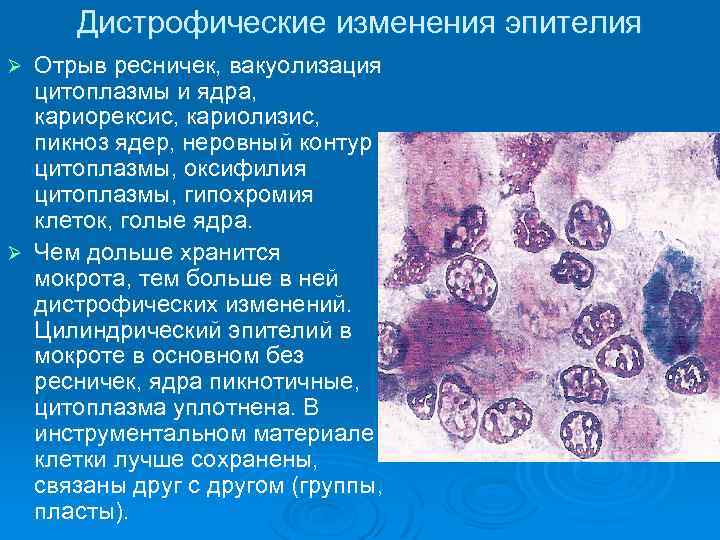 Дистрофические изменения эпителия Отрыв ресничек, вакуолизация цитоплазмы и ядра, кариорексис, кариолизис, пикноз ядер, неровный