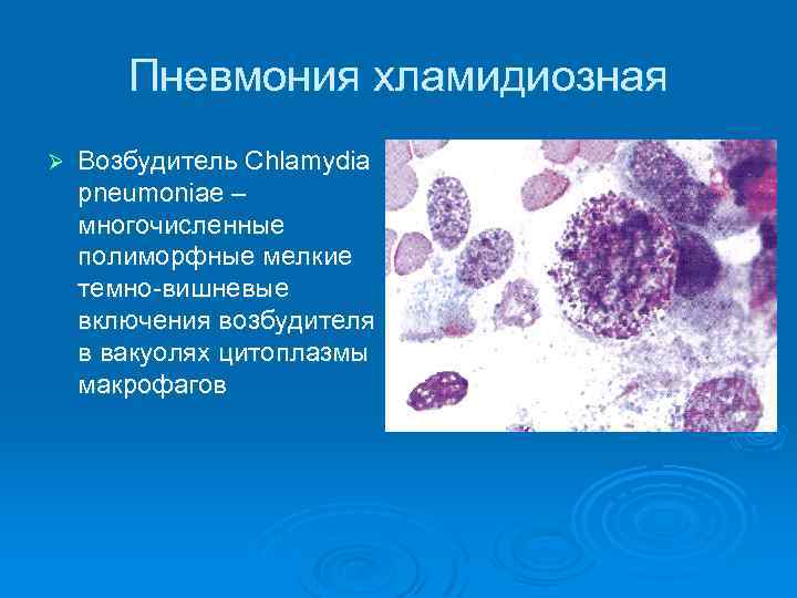 Пневмония хламидиозная Ø Возбудитель Chlamydia pneumoniae – многочисленные полиморфные мелкие темно-вишневые включения возбудителя в