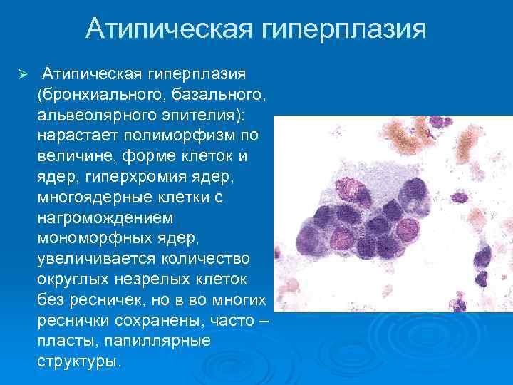 Атипическая гиперплазия Ø Атипическая гиперплазия (бронхиального, базального, альвеолярного эпителия): нарастает полиморфизм по величине, форме