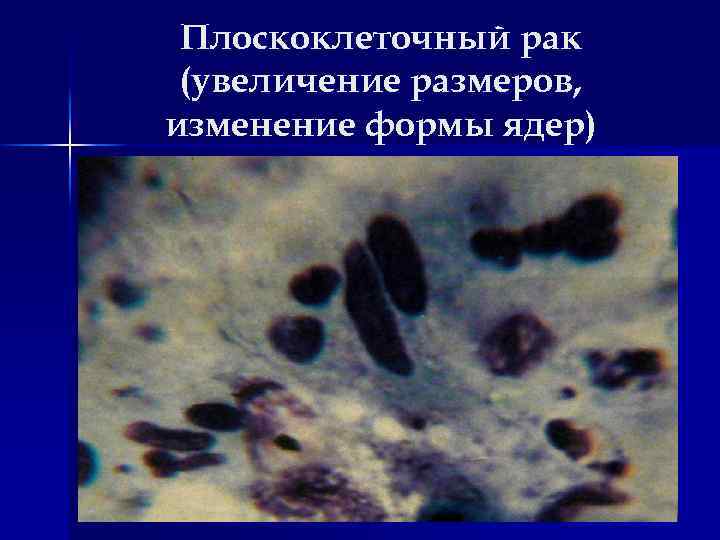 Плоскоклеточный рак (увеличение размеров, изменение формы ядер) 