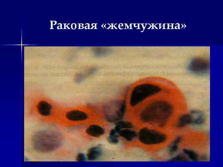 Раковая «жемчужина» 