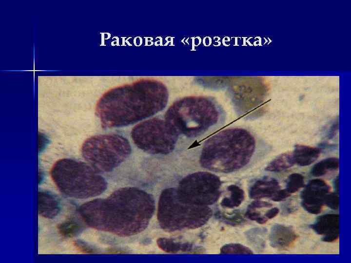 Раковая «розетка» 