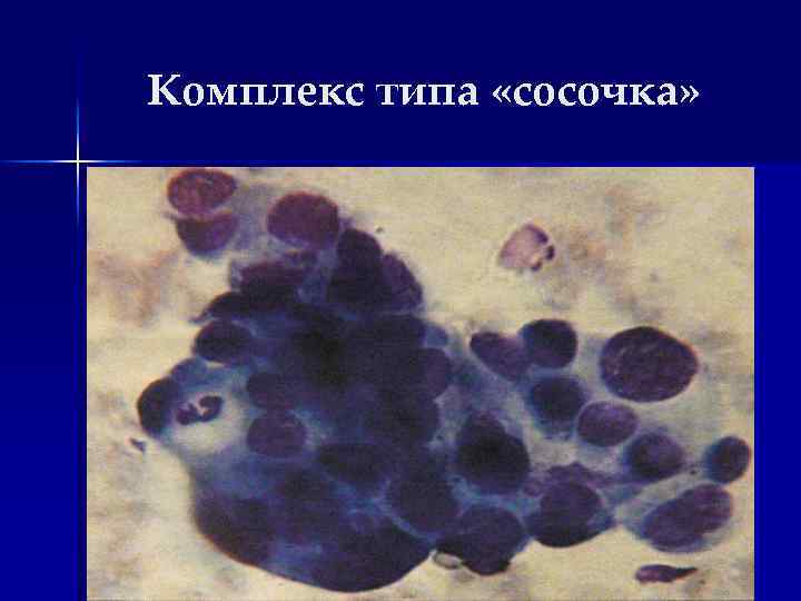 Комплекс типа «сосочка» 