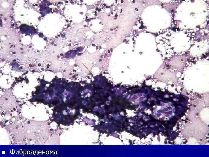 n Фиброаденома 
