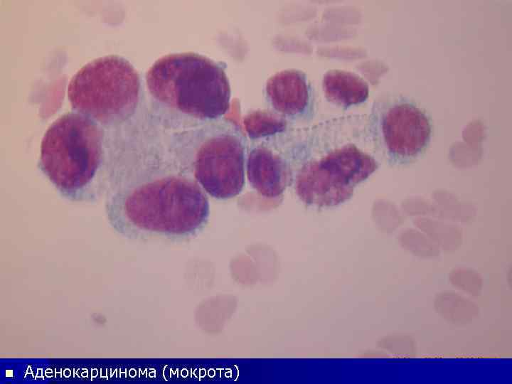 n Аденокарцинома (мокрота) 
