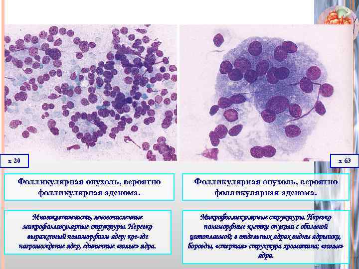 х 20 х 63 Фолликулярная опухоль, вероятно фолликулярная аденома. Многоклеточность, многочисленные микрофолликулярные структуры. Нерезко