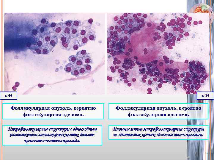 Цитологическая картина фолликулярной опухоли щитовидной железы bethesda iv