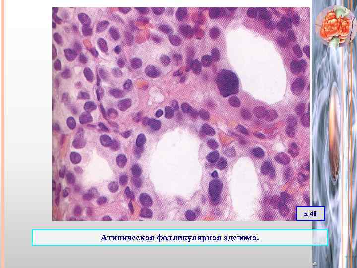 х 40 Атипическая фолликулярная аденома. 