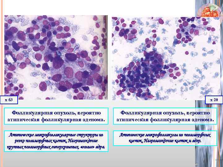 х 63 х 20 Фолликулярная опухоль, вероятно атипическая фолликулярная аденома. Атипические микрофолликулярные структуры из