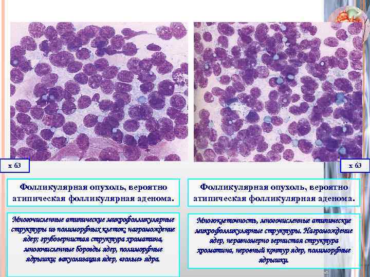 х 63 Фолликулярная опухоль, вероятно атипическая фолликулярная аденома. Многочисленные атипические микрофолликулярные структуры из полиморфных