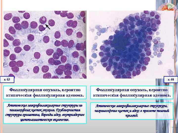 Цитологическая картина фолликулярной в клеточной опухоли щитовидной железы bethesda iv