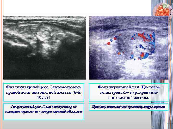 Фолликулярный рак. Эхотомограмма правой доли щитовидной железы (б-й, 19 лет) Фолликулярный рак. Цветовое допплеровское