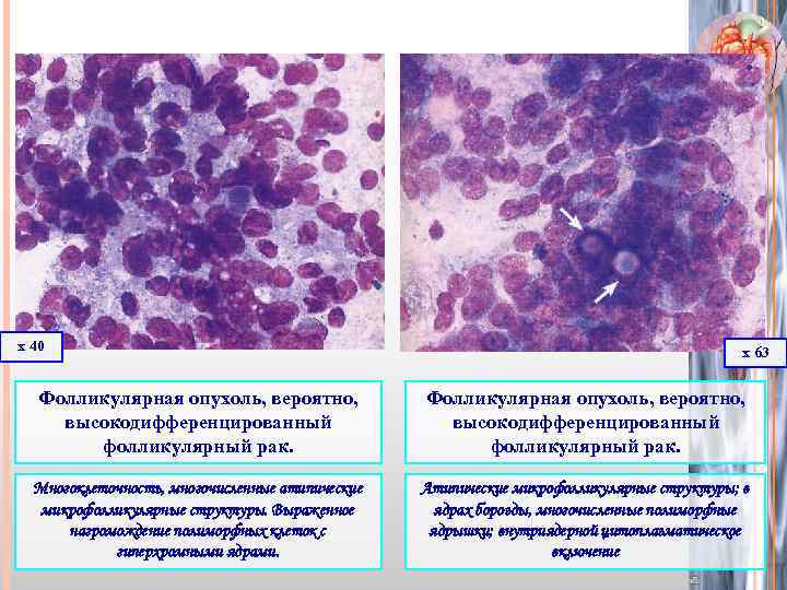 х 40 х 63 Фолликулярная опухоль, вероятно, высокодифференцированный фолликулярный рак. Многоклеточность, многочисленные атипические микрофолликулярные