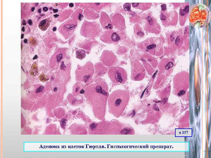 х 157 Аденома из клеток Гюртля. Гистологический препарат. 